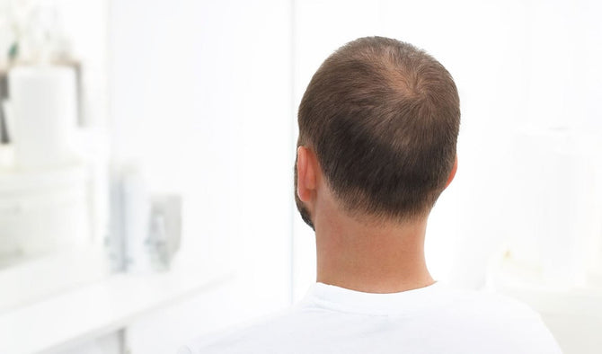 5 raisons différentes pour lesquelles les cheveux sont fins chez les hommes 