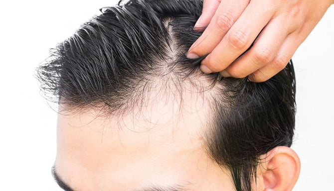 Fièvre : la perte de cheveux comme effet secondaire ?