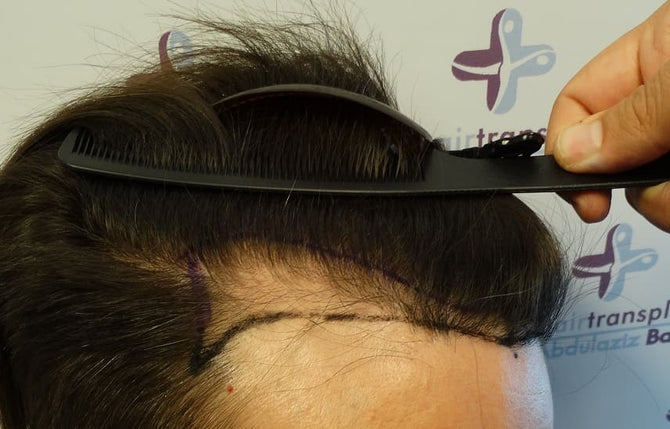 La perte de cheveux peut-elle être causée par un coup de soleil ?