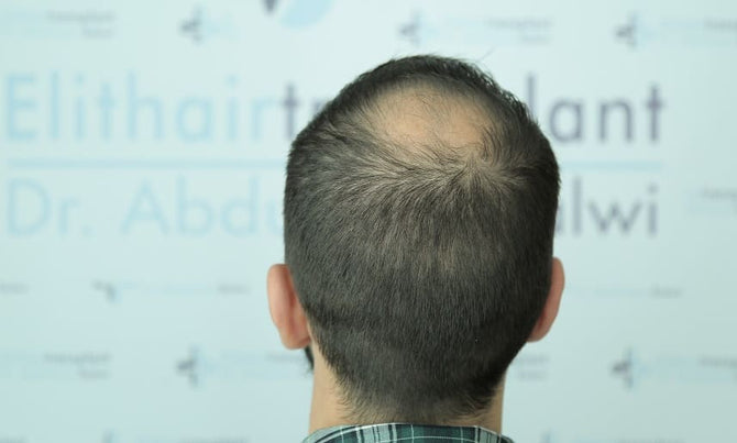 Colite ulcéreuse : la perte de cheveux comme effet secondaire ?
