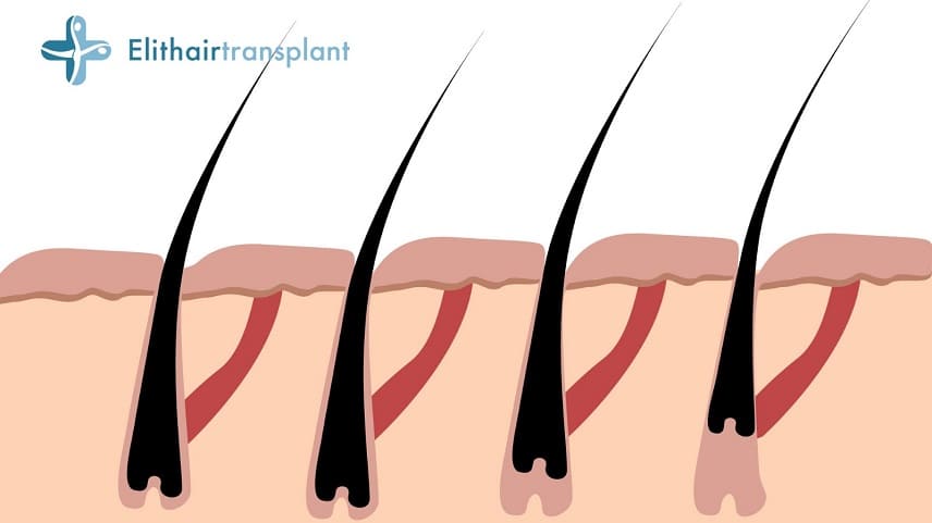 Haarausfall mit Wurzel