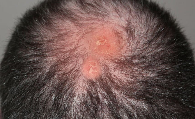 Existe-t-il un traitement contre la folliculite décalvante ?