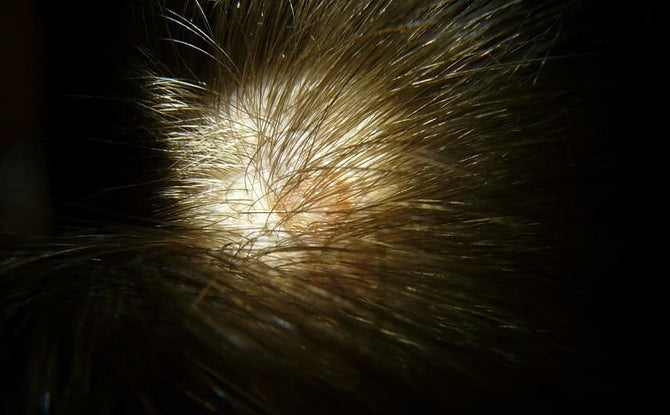 Lichen plan avec chute de cheveux : quel traitement est possible ?