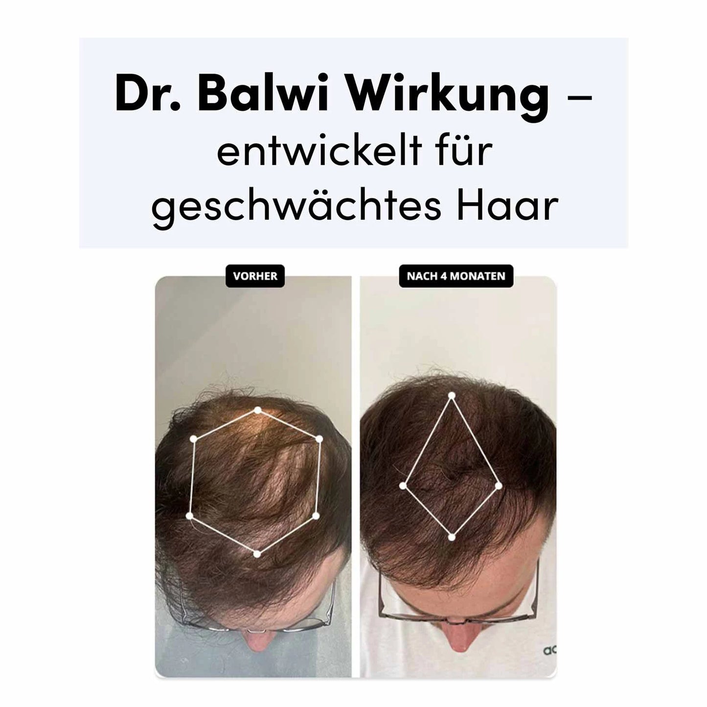 Fotos nebeneinander: Der Kopf eines Mannes zeigt den Haarfortschritt mit Dr. Balwi Shampoo aus dem Dr. Balwi Shop. Vorher (links) zeigt dünner werdendes Haar; Nach 4 Monaten (rechts) zeigt volleres Haar. Entwickelt für geschwächtes Haar.