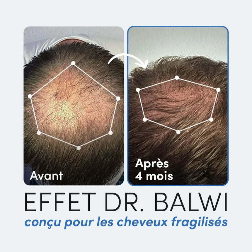 Nahaufnahme des Oberkopfes einer Person vor (links) und nach (rechts) 4 Monaten, die eine erhöhte Haardichte zeigt. Französischer Text: Effet Dr. Balwi conçu pour les cheveux fragilisés.