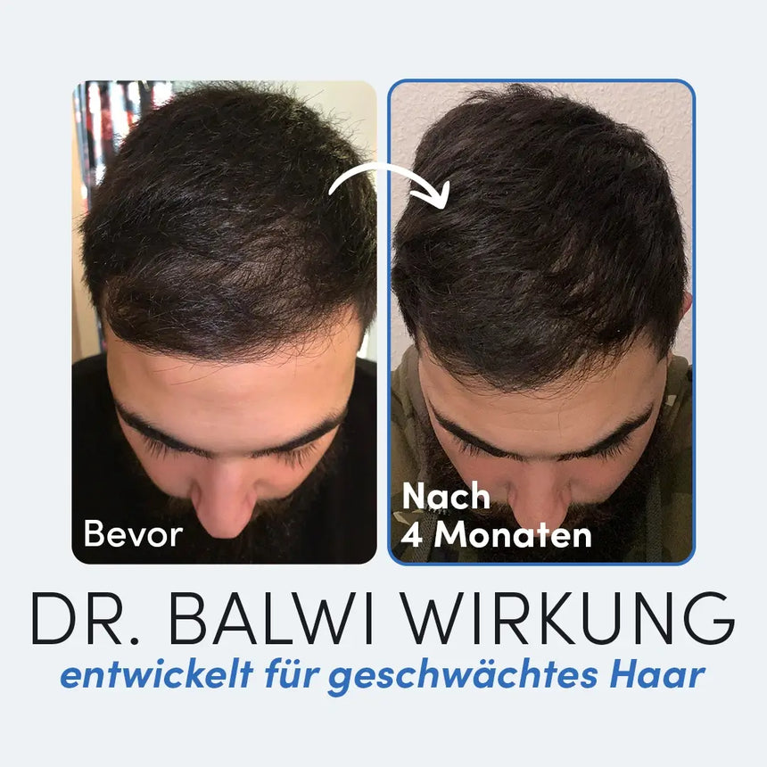 Zwei nebeneinander liegende Fotos zeigen den Oberkopf eines Mannes: links (Bevor) mit schütterem Haar, rechts (Nach 4 Monaten) mit vollerem Haar - Dr. Balwi Meso Therapie (Refill) aus dem Dr. Balwi Shop hilft, Haarwachstum sichtbar zu fördern.