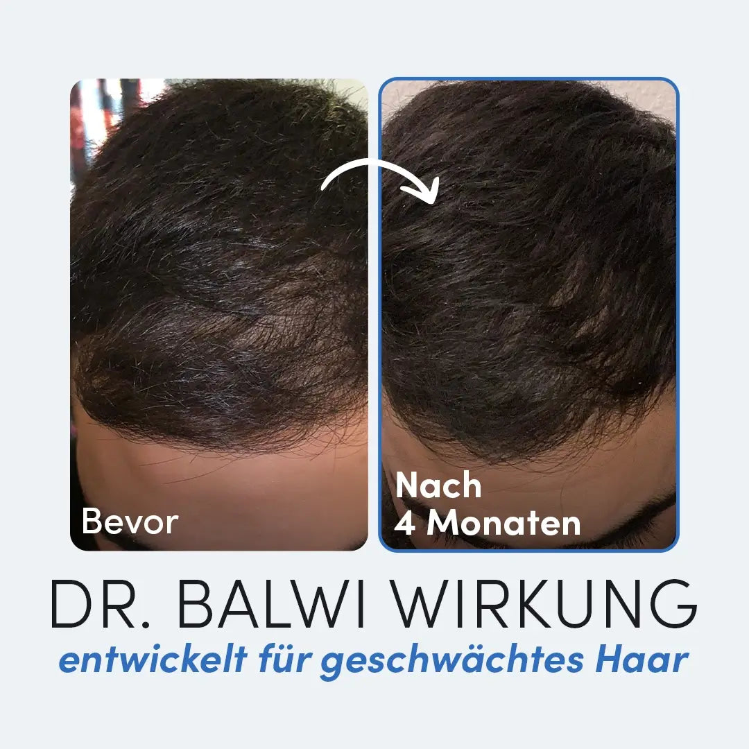 Seitenvergleich einer Kopfhaut: links mit der Aufschrift "Vorher" mit schütterem Haar, rechts mit der Aufschrift "Nach 4 Monaten" mit vollerem Haar. Text: Mikrofaser Kopfhandtuch von Dr. Balwi Shop - entwickelt für geschwächtes Haar.