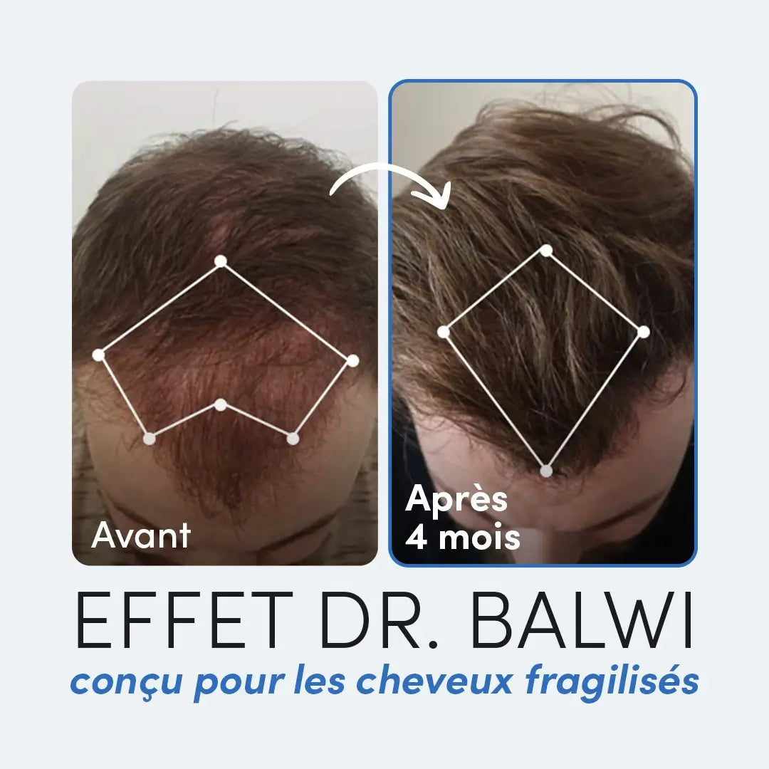 Docteur Ensemble de mésothérapie Balwi