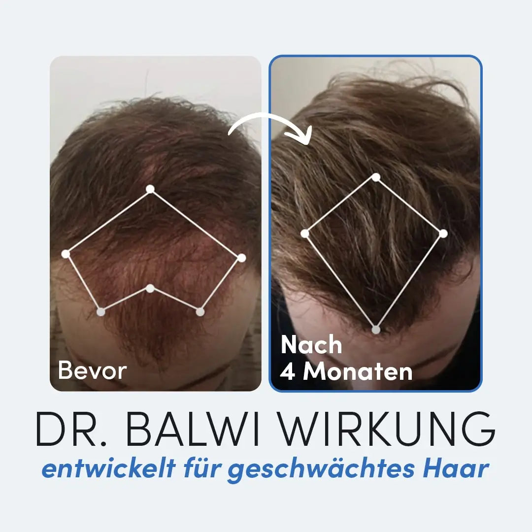 Zwei Fotos der Kopfhaut eines Mannes in der Draufsicht zeigen das Nachwachsen der Haare über vier Monate. Das linke, mit "Bevor" beschriftete Bild zeigt dünner werdendes Haar, das möglicherweise auf einen Vitamin-D-Mangel zurückzuführen ist; das rechte, "Nach 4 Monaten mit Dr. Balwi Shop Vitamin D 1000 IE", zeigt volleres Haar.
