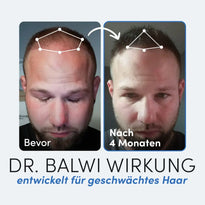 Seite an Seite Fotos der Kopfhaut eines Mannes vor und nach 4 Monaten Anwendung der Anti-Haarausfall-Routine von Dr. Balwi Shop. Links: deutliche Ausdünnung; rechts: sichtbar volleres Haar. Weiße Linien umreißen den Haaransatz. Text: Bevor, nach 4 Monaten, Dr. Balwi Wirkung.