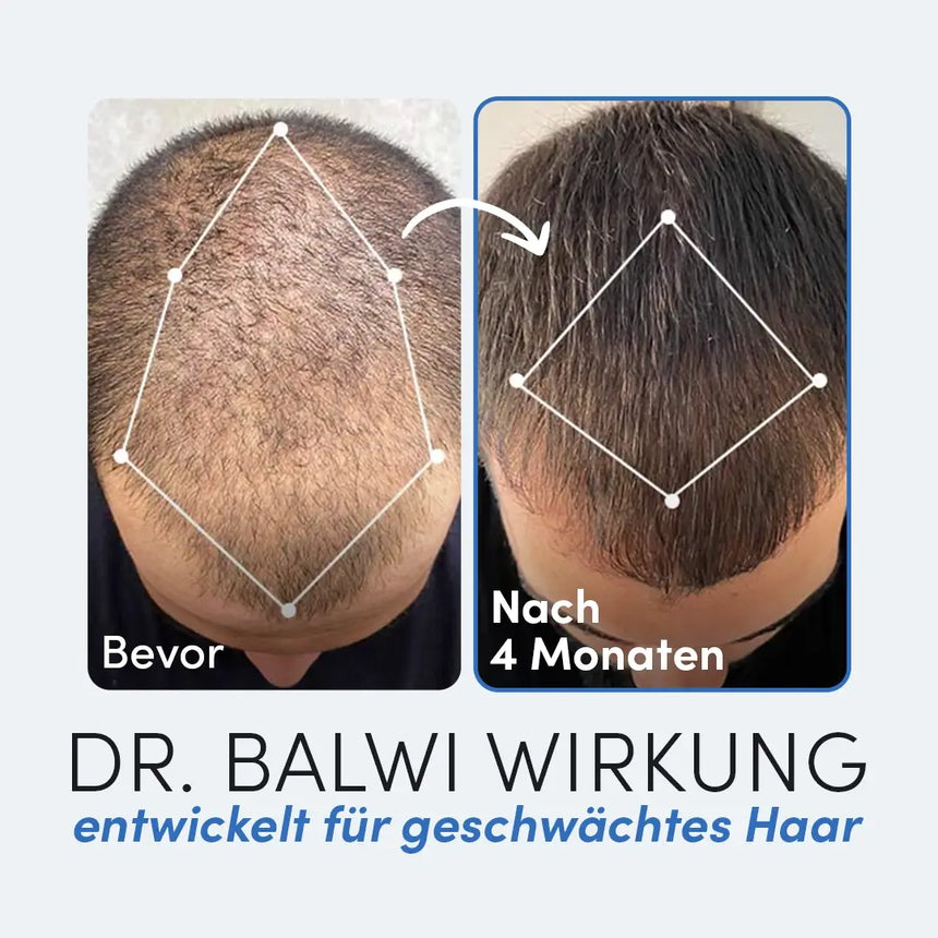Zwei nebeneinander liegende Fotos zeigen das Haarwachstum: dünnes Haar mit der Aufschrift "Bevor" und volleres Haar nach 4 Monaten mit der Aufschrift "Nach 4 Monaten". Der Text unten hebt das Premium Schwarzkümmelöl von Dr. Balwi Shop für die Haarausfallbehandlung hervor.