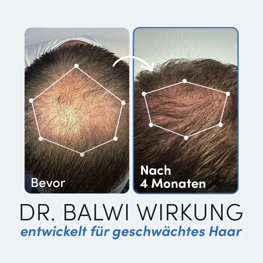 Nebeneinanderstehende Fotos zeigen den Fortschritt des Haarwachstums: links (Bevor) mit schütterem Haar, rechts (Nach 4 Monaten) mit vollerem Haar. Die Ergebnisse wurden mit dem Dr. Balwi Dermaroller aus dem Dr. Balwi Shop erzielt; Microneedling Haare fördert das sichtbare Wachstum.