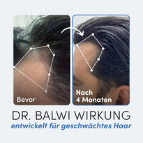 Nebeneinanderstehende Fotos zeigen den Haaransatz eines Mannes vor und nach 4 Monaten mit dem Dr. Balwi Hair Boost Set aus dem Dr. Balwi Shop und offenbaren mehr Haardichte und sichtbares Haarwachstum - entwickelt für geschwächtes Haar.