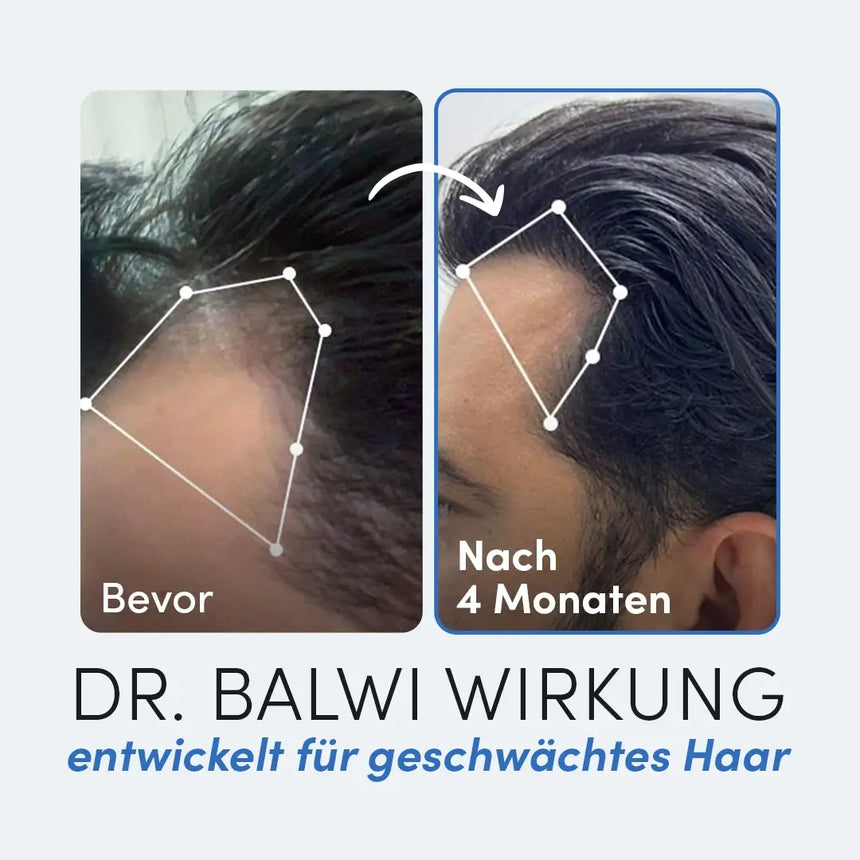 Nebeneinanderstehende Fotos zeigen den Haaransatz eines Mannes vor und nach der Behandlung. Das linke (Vorher) zeigt spärliches Haar, das rechte zeigt volleres Haarwachstum nach 4 Monaten. Der Text darunter wirbt für Zink Tabletten aus dem Dr. Balwi Shop.